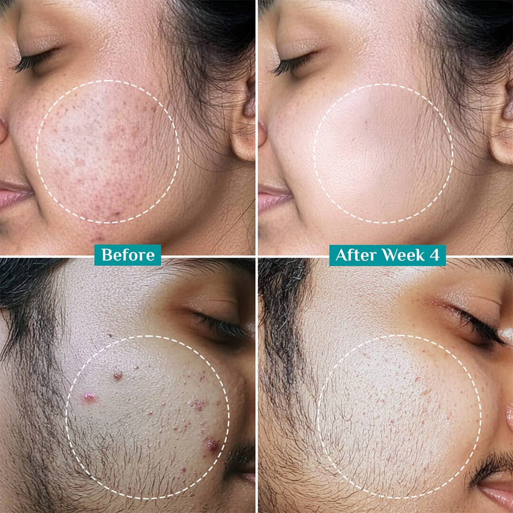 2% Salicylic Acid Anti-Acne Face Serum